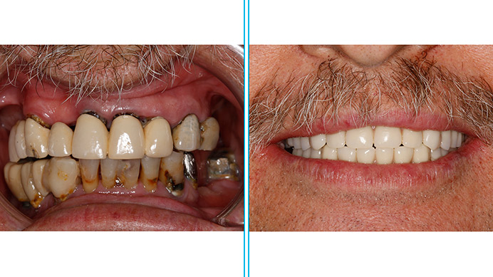 antes despues implantes dentales de carga inmediata