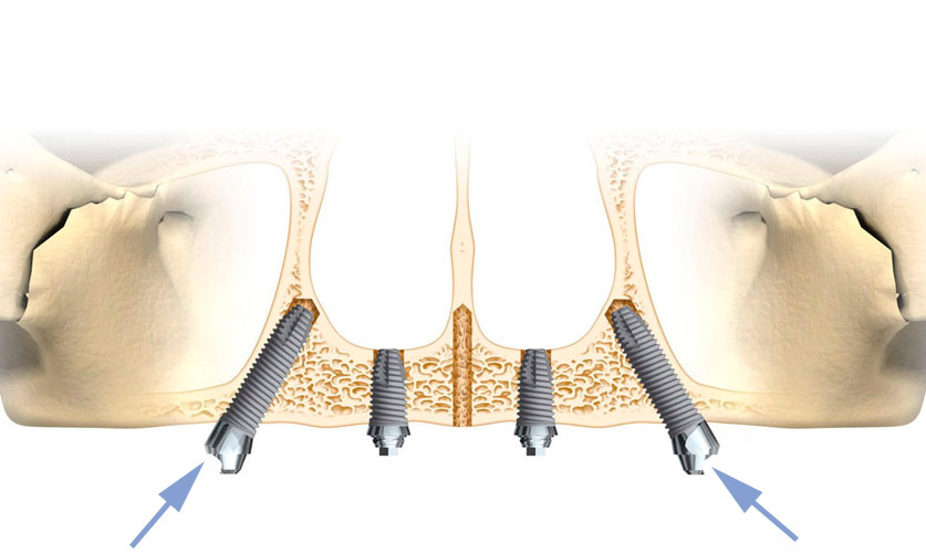 implantes dentales inclinados