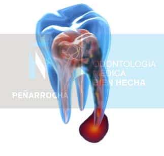 caries causa endodoncia mal hecha idim clinica de implantes dentales en valencia