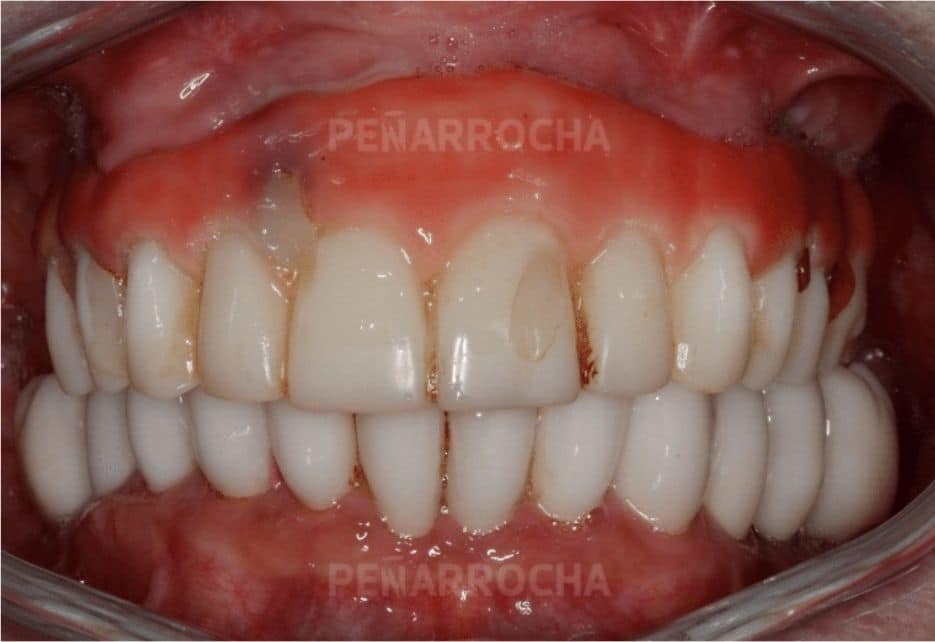 casos de exito 1 implantes sin hueso idim clinica de implantes dentales en valencia
