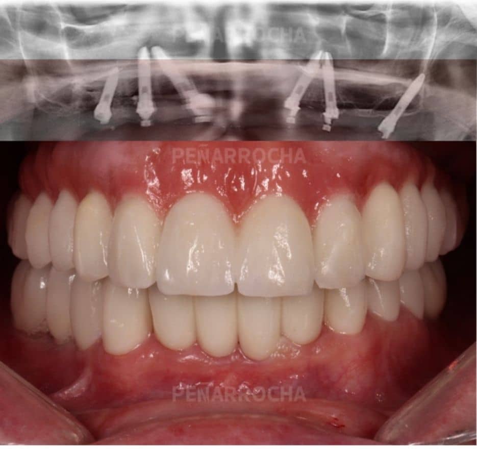 casos de exito 2 implantes sin hueso idim clinica de implantes dentales en valencia