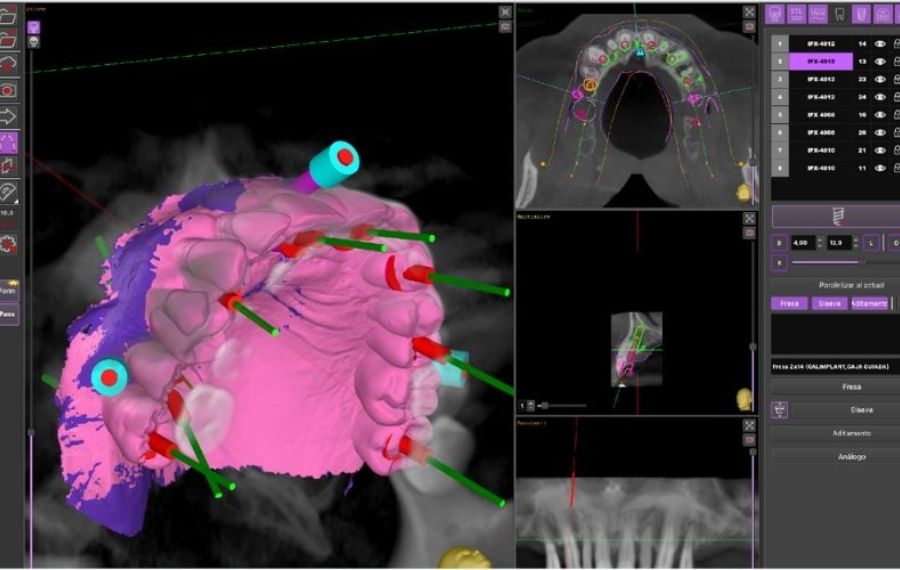 cirugia guiada implantes dentales