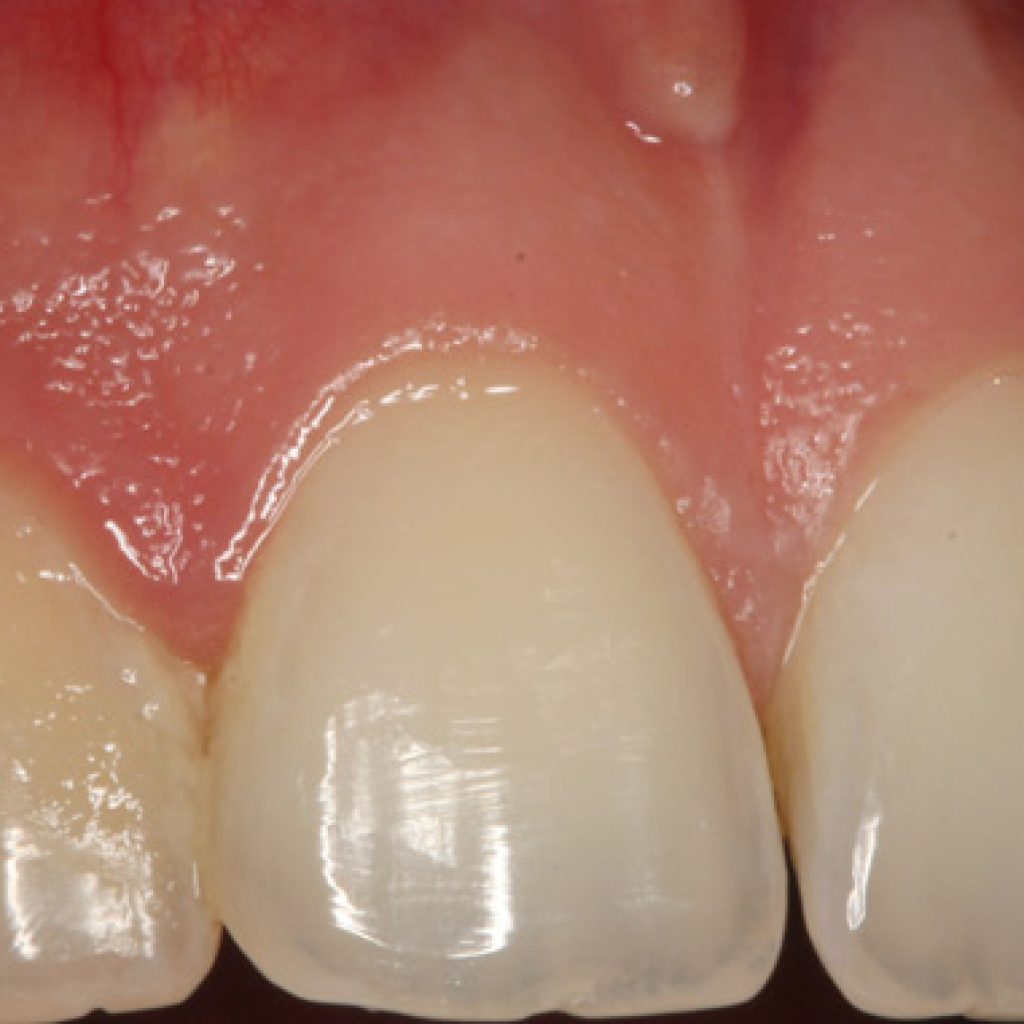 cirugia periapical el ultimo paso antes de extraer el diente