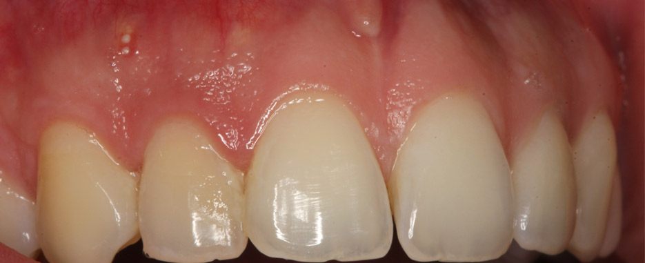 cirugia periapical el ultimo paso antes de extraer el diente