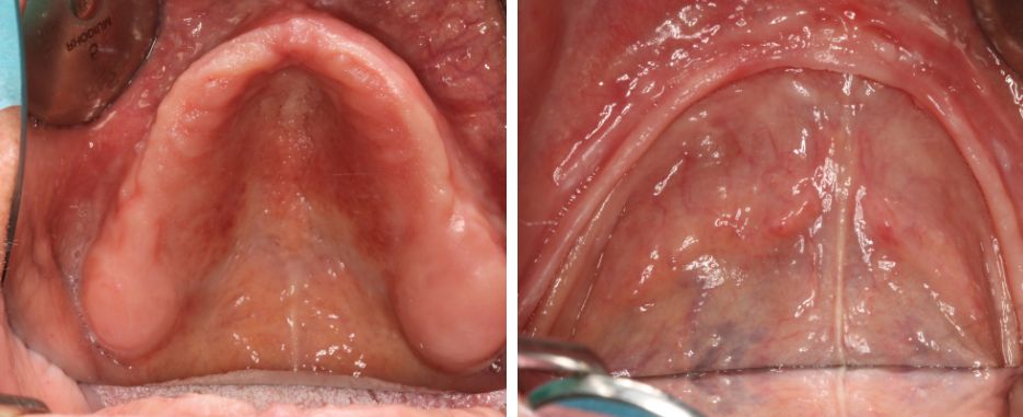 implantologia dental en pacientes con poco hueso clinica especializada en implantologia dental con poco hueso