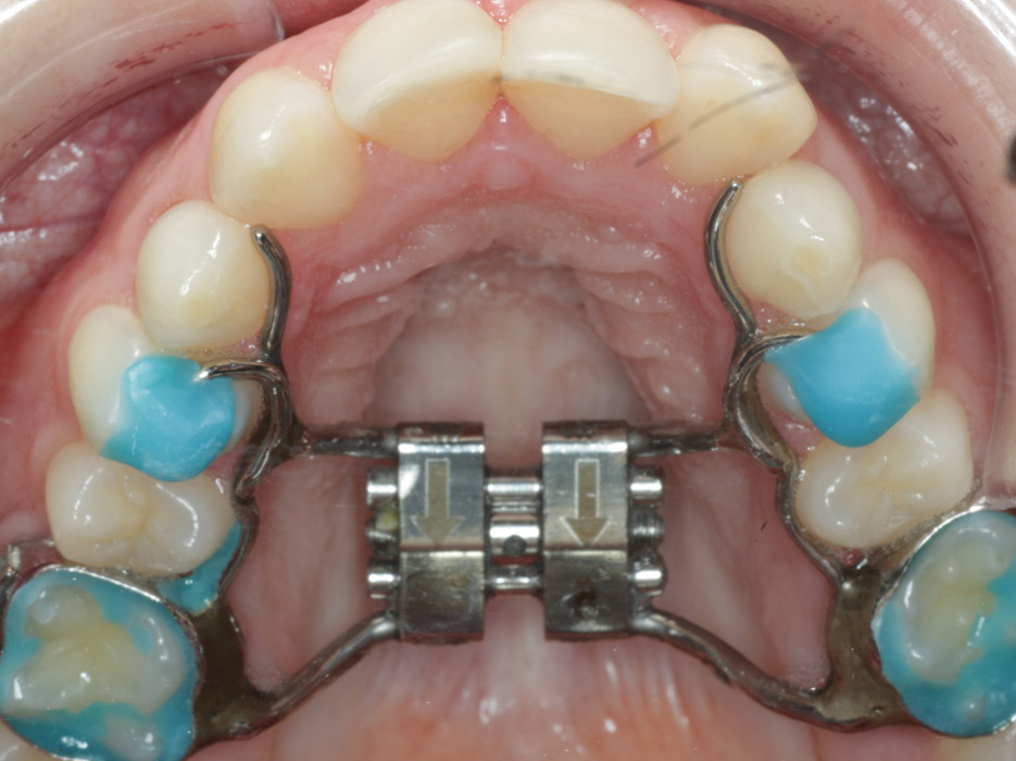 que es la mordida en tijera como solucionar mordida en tijera