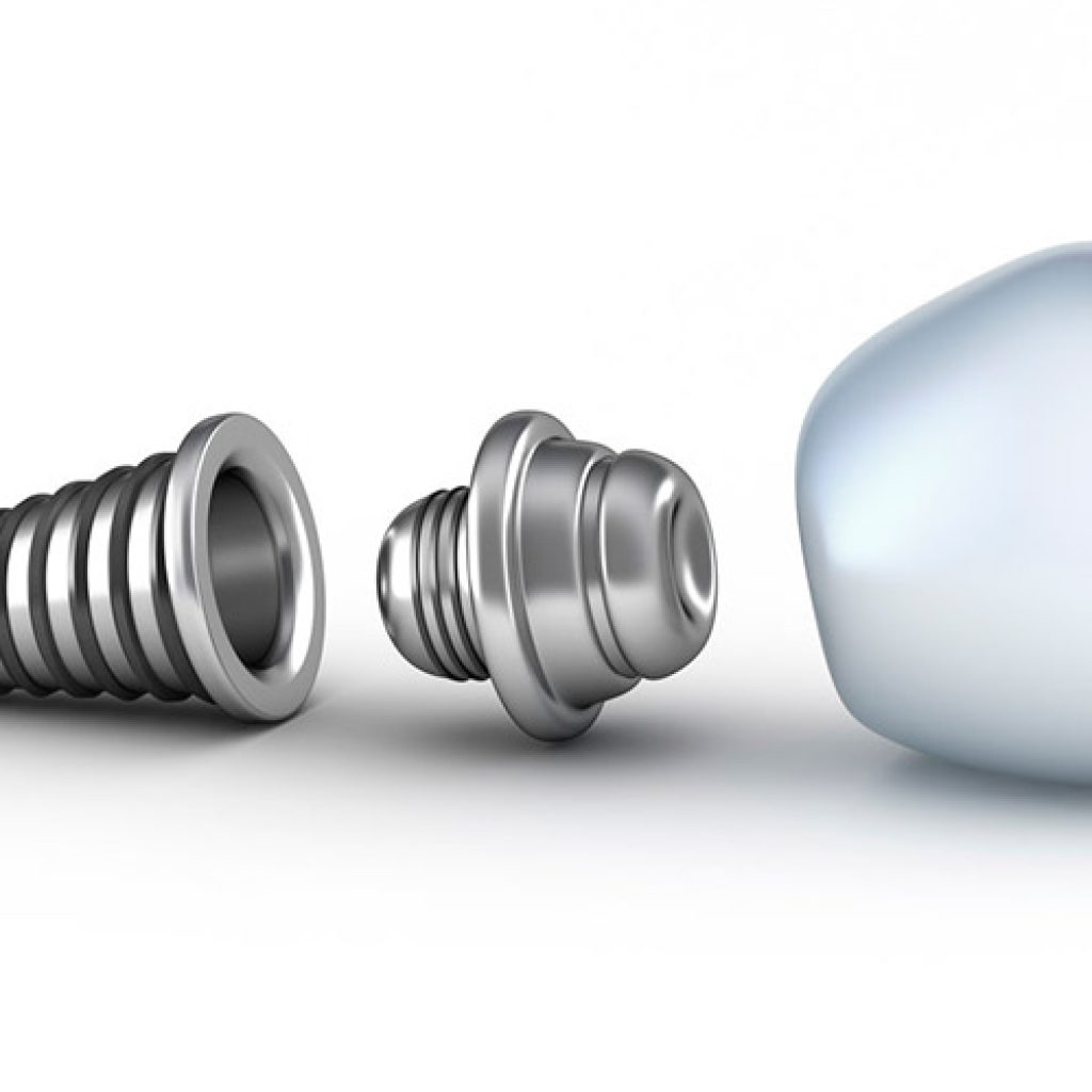 complicaciones mas frecuentes con implantes dentales