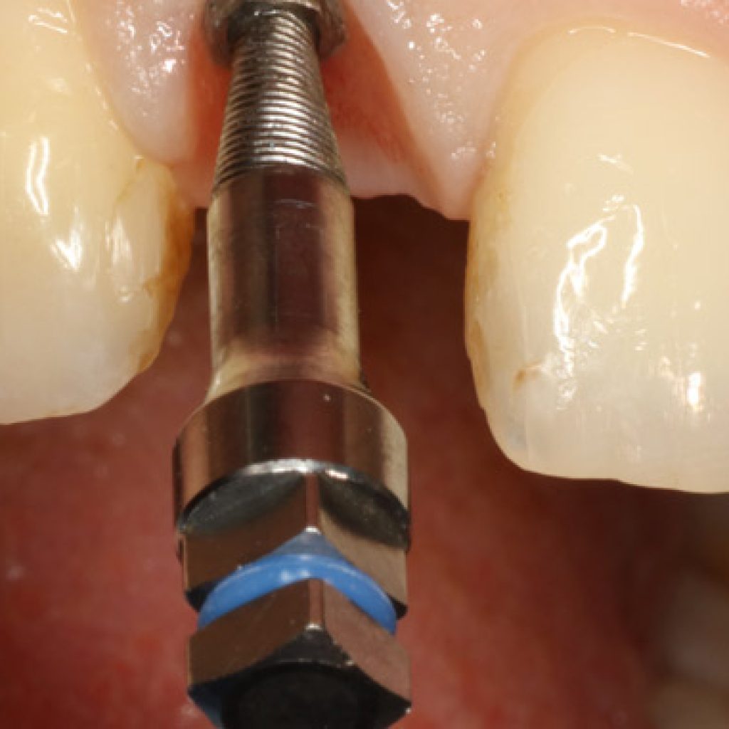 consecuencias al quitar un implante