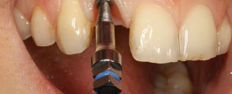 consecuencias al quitar un implante