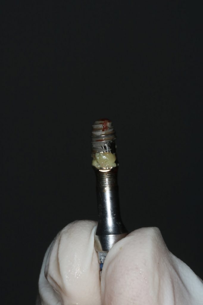 consecuencias de quitar un implante