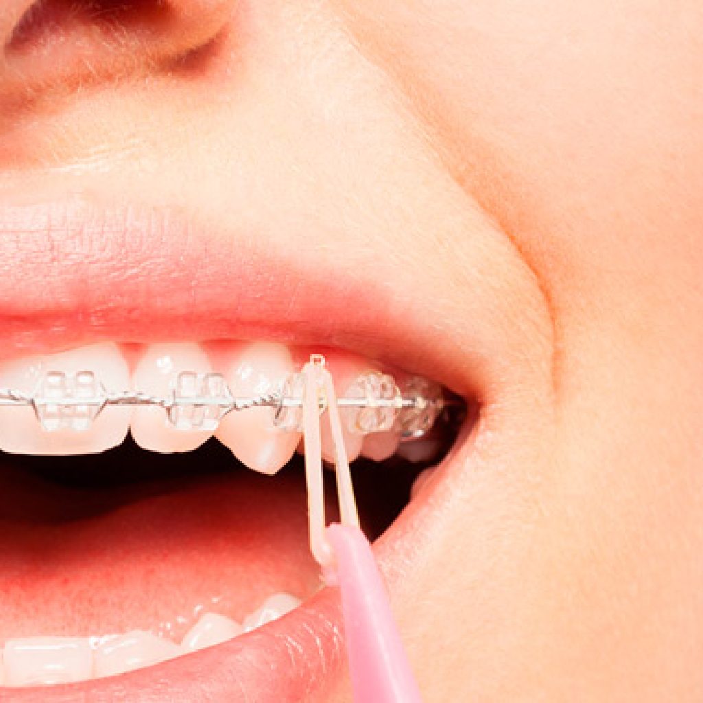 consejos para el dolor por brackets recien puestos