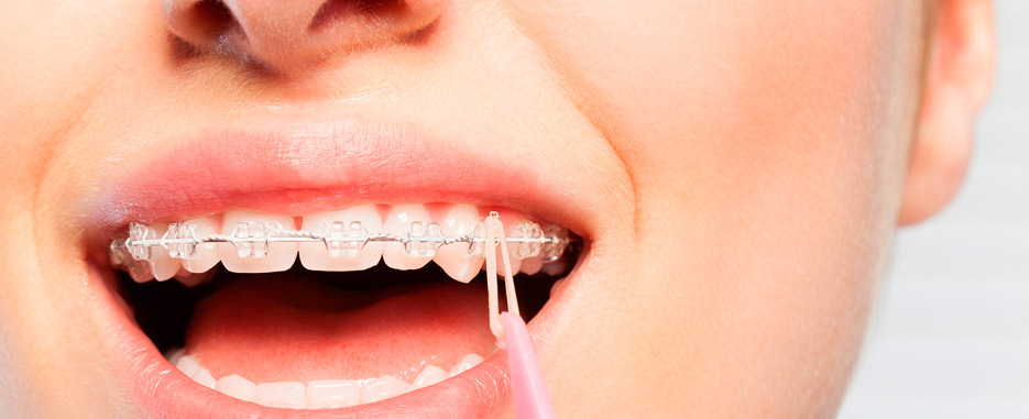 consejos para el dolor por brackets recien puestos