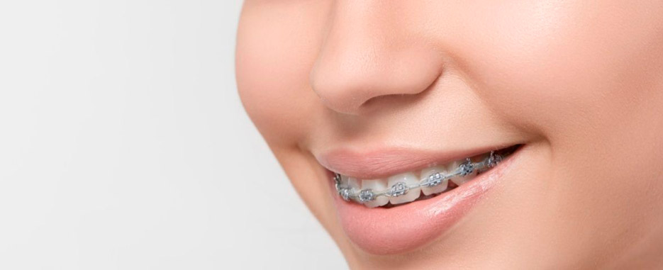 que comer con brackets recien puestos cual es la dieta ideal durante los primeros dias con brackets