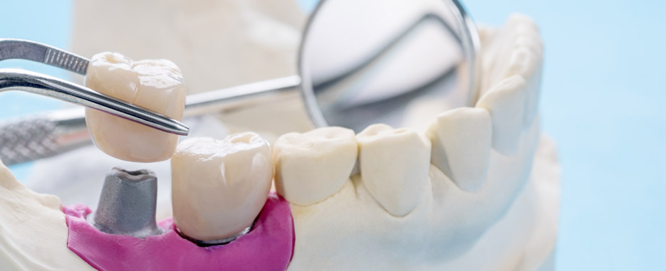 cuando acudir al implantologo dental