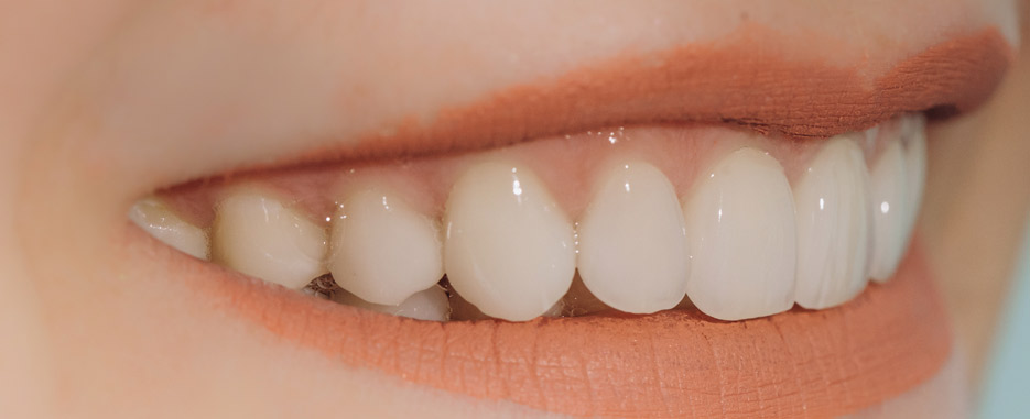 cuantos implantes se necesitan para la mandibula