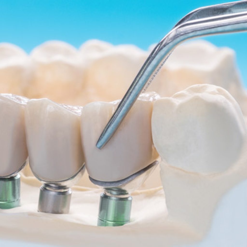 cuantos implantes se necesitan para una dentadura completa