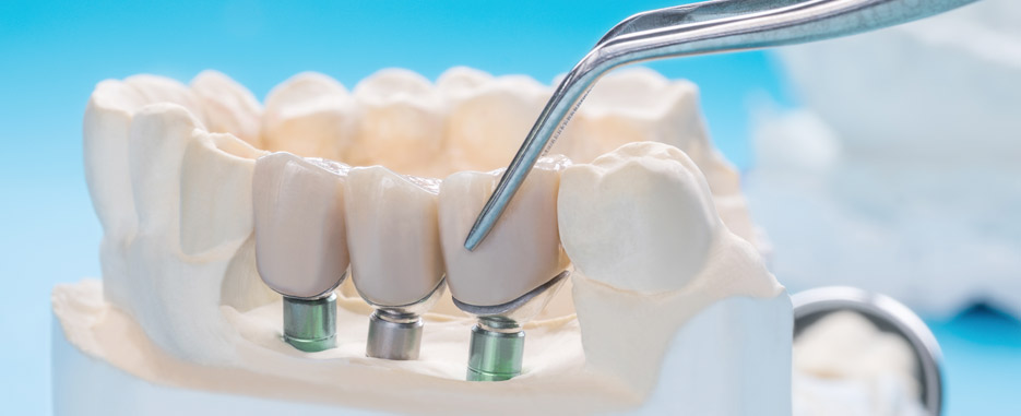 cuantos implantes se necesitan para una dentadura completa