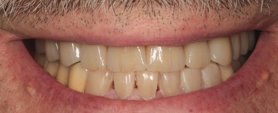 despues de realizar estetica en cirugia bucal e implantes