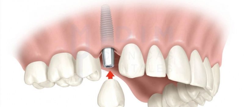 dientes en un dia en valencia