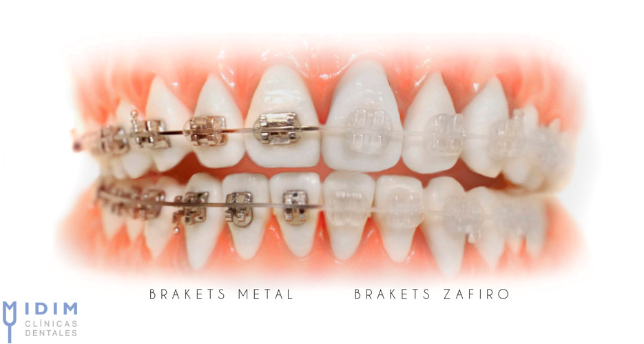 Brackets metal y brackets zafiro Brackets tradicionales e invisibles