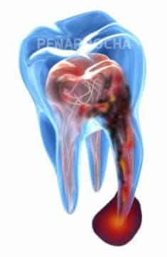 dolor-implantes dolor implante poner un implante dental duele cuanto duelen los implantes dentales