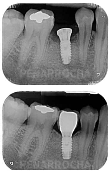 dolor-implantes dolor implantes poner un implante dental duele