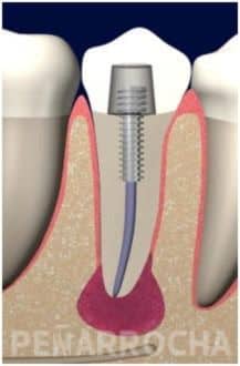 dolor-implantes dolor implantes dentales poner un implante dental duele consejos para prevenir molestias implantes dentales