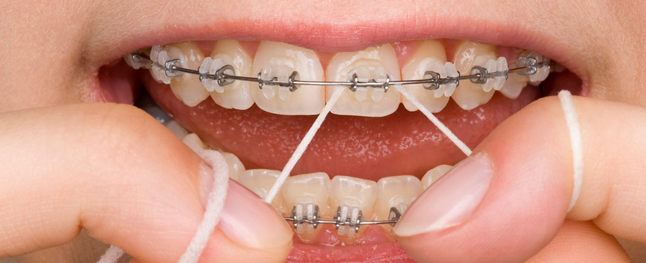 el cuidado de la higiene de los brackets es muy importante