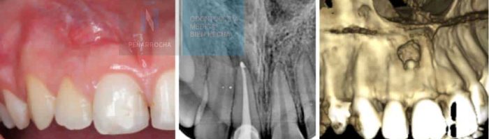 ejemplo endodoncia mal hecha portada idim clinica de implantes dentales en valencia