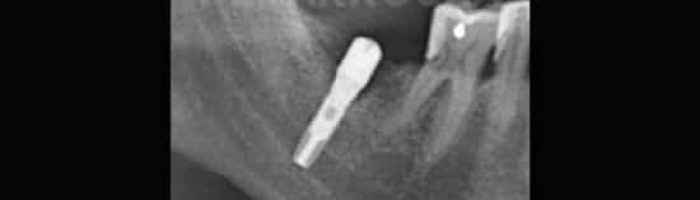cuanto duelen los implantes dentales poner un implante dental duele