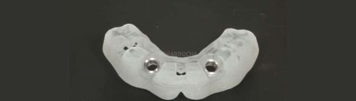 implantes dentales en un dia IDIM clinica de implantes dentales en valencia