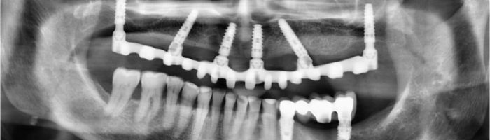 implantes pterigoideos2 tratamiento implantes sin hueso idim clinica de implantes dentales en valencia
