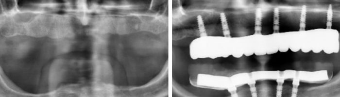 poco hueso maxilar por que se produce la atrofia maxilar IDIM clinica implantes dentales valencia