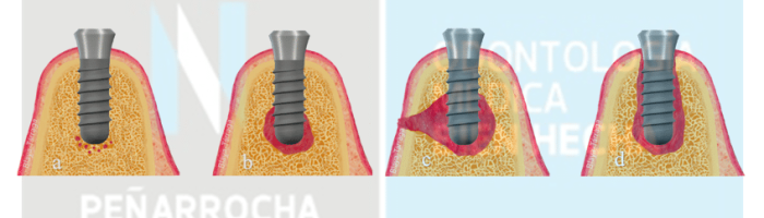 portada fracaso de implantes dentales causas tratamientos idim clinica de implantes dentales en valencia