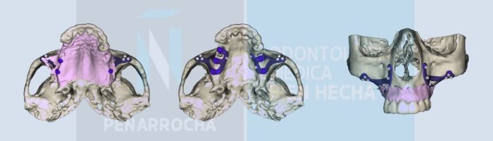 portada implantes dentales sin tornillos idim clinica de implantes dentales en valencia