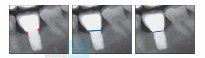 portada implantes inmediatos idim clinica de implantes dentales en valencia