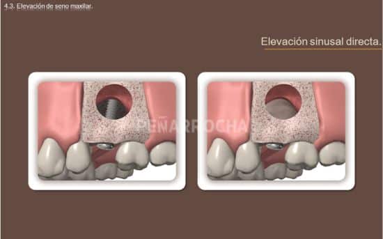 elevacion de seno directa tratamiento implantes sin hueso idim clinica de implantes dentales en valencia