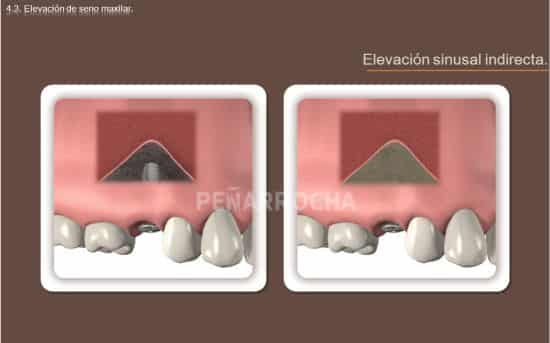elevacion de seno indirecta tratamiento implantes sin hueso idim clinica de implantes dentales en valencia