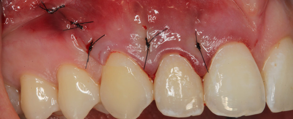 en que consiste la cirugia periapical