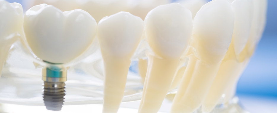 en que momento acudir al implantologo dental