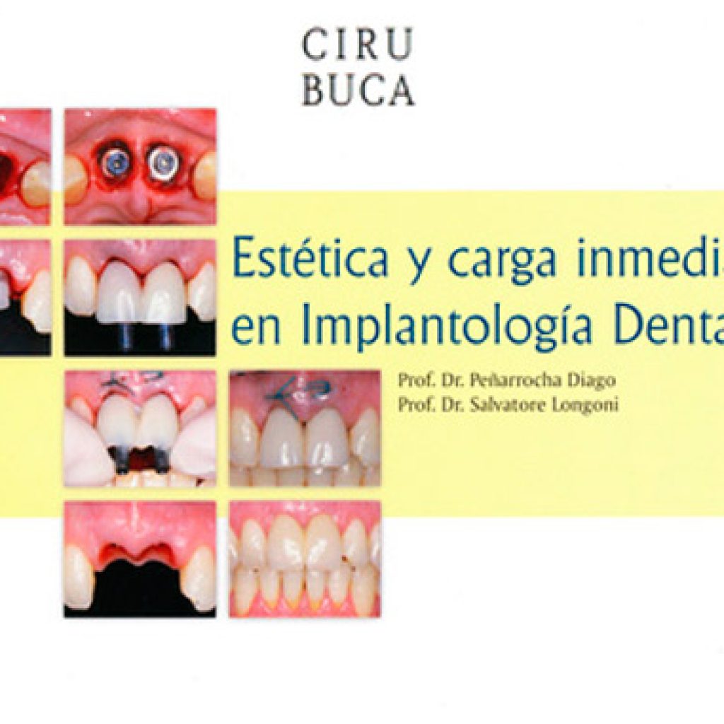 estetica y carga inmediata en implantologia dental