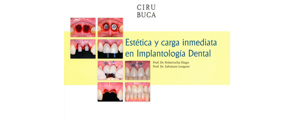 estetica y carga inmediata en implantologia dental