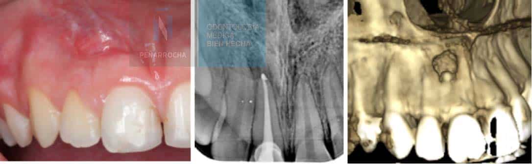 example failed root canal treatment idim dental implant clinic in Valencia