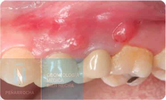 fistula symptom of failed root canal idim dental implant clinic in valencia