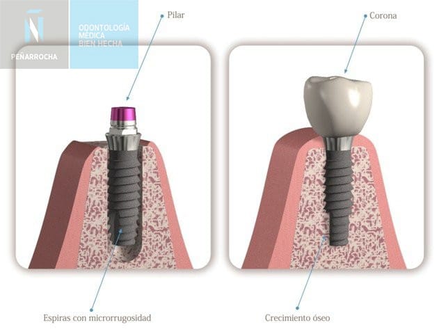 fracaso de implantes dentales IDIM clinica de implantes dentales en Valencia