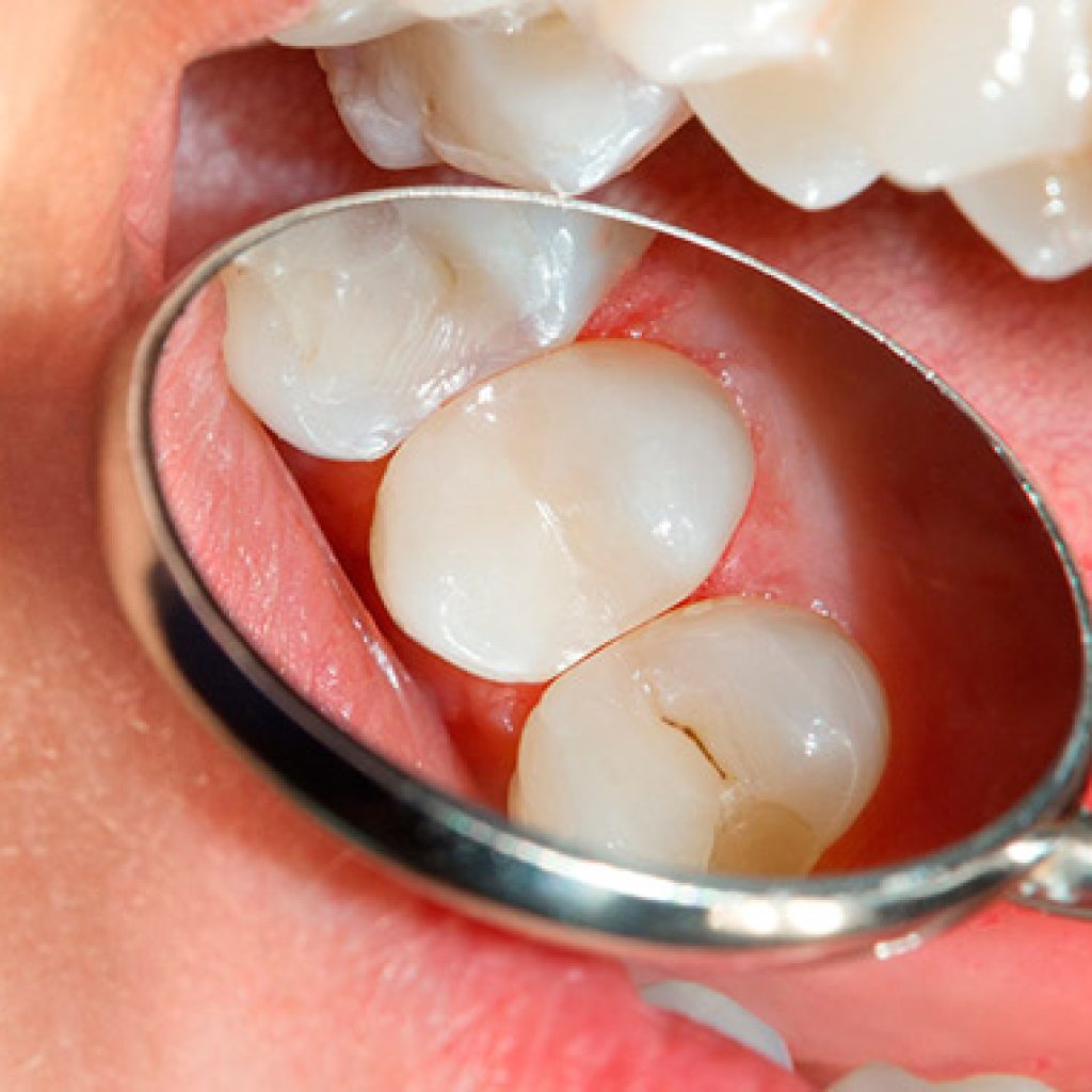 fumadores e implantes dentales