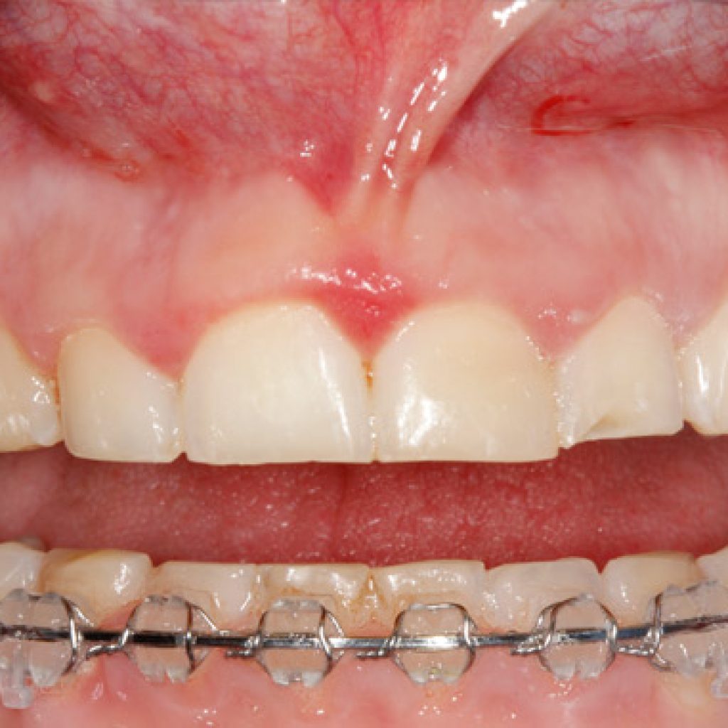 gingivectomia o alargamiento coronario