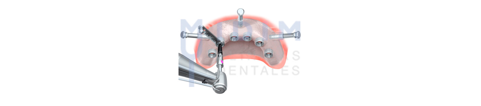 imagen labrado lecho implantes dentales sin cirugia imagen labrado lecho implantes dentales sin cirugia
