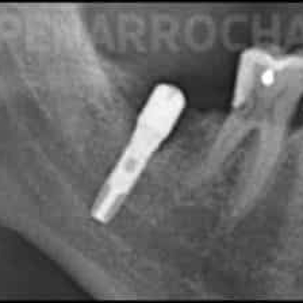 cuanto duelen los implantes dentales poner un implante dental duele