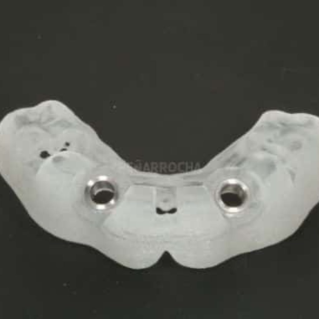 implantes dentales en un dia IDIM clinica de implantes dentales en valencia